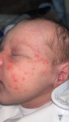 Baby acne or milk allergy.? Baby so upset after milk Pictures attached