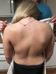 Is this scoliosis ? DD 17