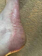 Can anyone help with my eczema? Horrible pics attached!