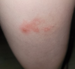 Help! Does this rash look familiar to anyone?