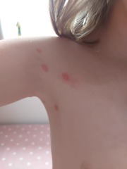 Bug bites or chickenpox?