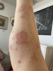 Does this look like a lupus rash?