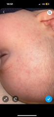 rash
