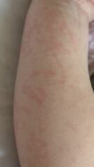20 month old rash
