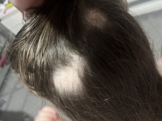 Bald spots on my 3.5 year old girls head