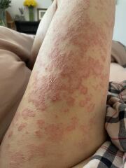 Does this look like a lupus rash?