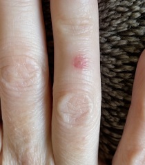 Spider bite?