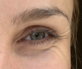 HELP! Creepy wrinkly skin around eyes at 27