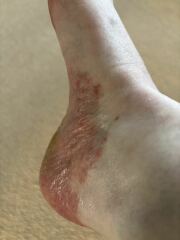 Can anyone help with my eczema? Horrible pics attached!