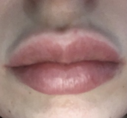 Did your lips wrinkle when dissolving lips?