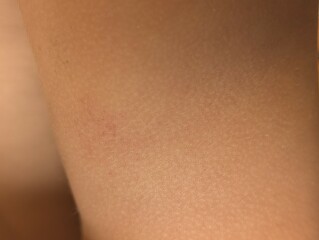 Night sweats and weird bruising