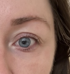 Is Botox the best thing for around the eyes?