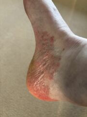 Can anyone help with my eczema? Horrible pics attached!