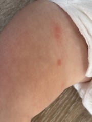 Rash advice on toddler (15 months)