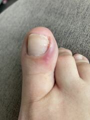 Is my toe infected? (Pictures)