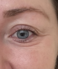 Is Botox the best thing for around the eyes?