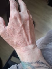 Hand infected (Warning, gross photos)