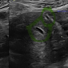 Pregnancy scan