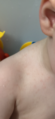 What does this rash look like?