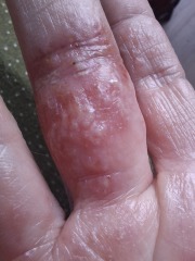 Hand infected (Warning, gross photos)