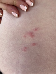 Shingles?