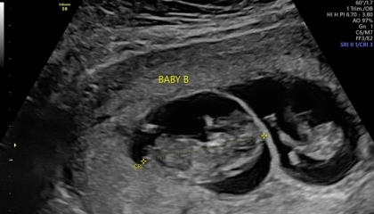 Sex of my Twin Babies