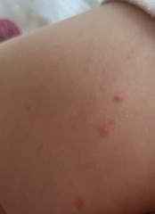Does this look like chicken pox? Also I’m pregnant so need advice if so!