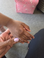 Does this rash on my 3 yr old look familiar?