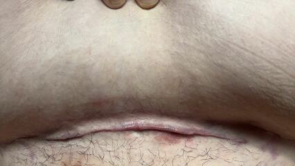 Infected c section??? *PICS*