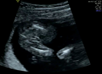 Gender Scan Help!