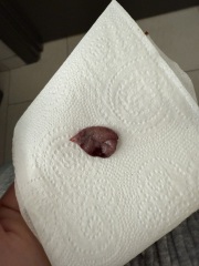 Blood clot or Miscarriage tissue?