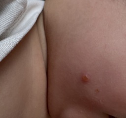 Molluscum contagiosum/acne/post viral spots?