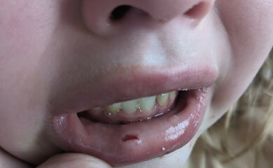 I think my DD has just bitten fully through her lip