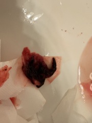 Is this discharge normal during miscarriage??