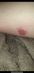 Is it Lyme?