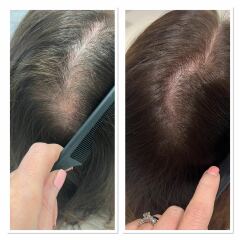 I’m having treatment for hair loss AMA