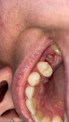 Does my tooth extraction look to be healing ok? Grim picture included