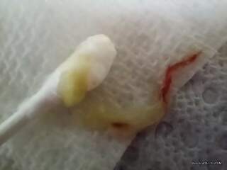 Can you blow a nasal polyp out? 