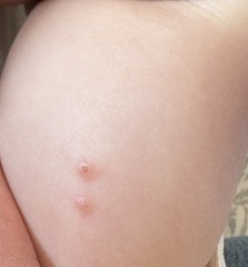 Molluscum contagiosum/acne/post viral spots?