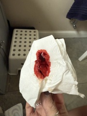 GRAPHIC PICS - Is this a miscarriage