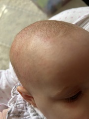 Eczema? 4 month old