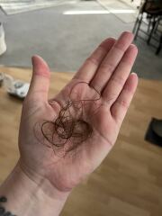 Female hair loss - please help