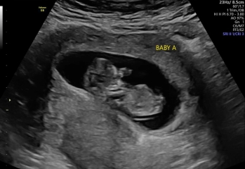 Sex of my Twin Babies