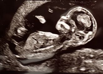 Sibling scan identical- same gender?