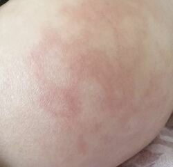 20 month old rash