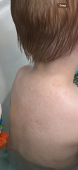 What does this rash look like?