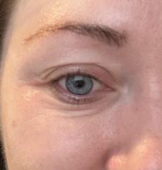 Is Botox the best thing for around the eyes?