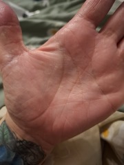 Hand infected (Warning, gross photos)