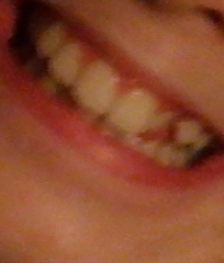 DD missing one lateral incisor