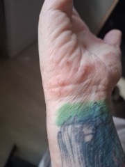 Hand infected (Warning, gross photos)